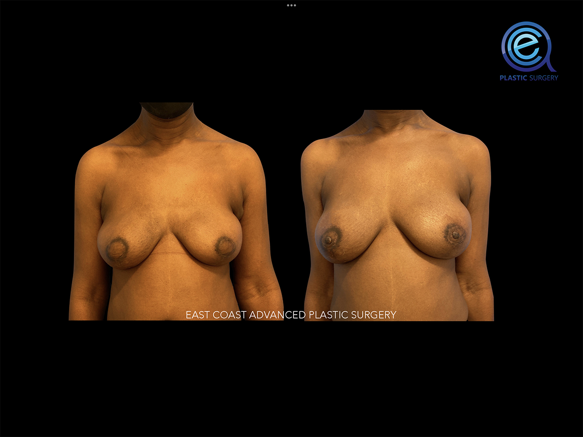 Nipple Reconstruction After Breast Reconstruction
