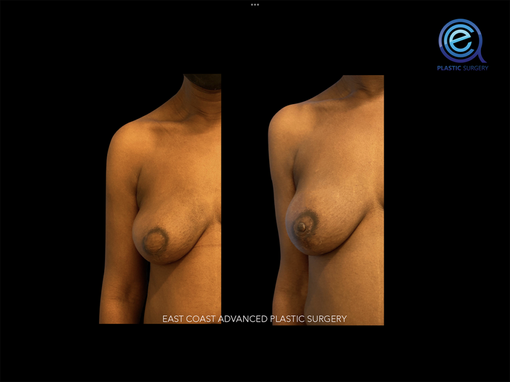 Nipple Reconstruction After Breast Reconstruction