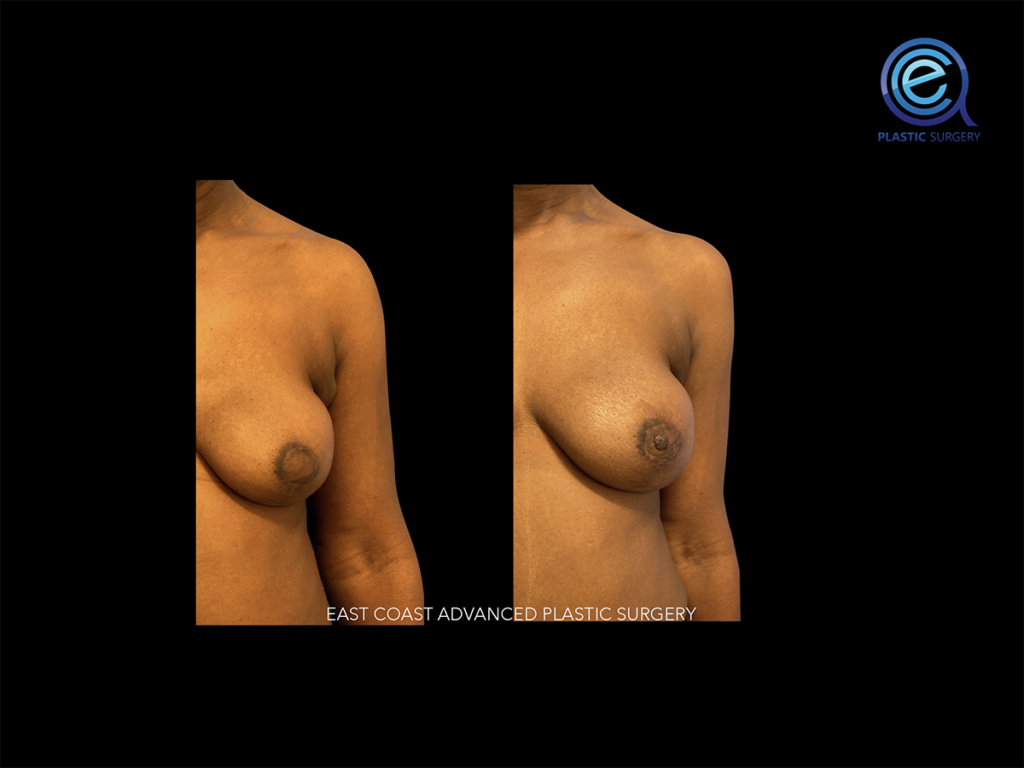 Nipple Reconstruction After Breast Reconstruction