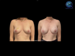 Bilateral Nipple Sparing Implant Based Reconstruction