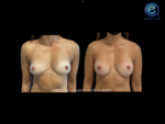 Bilateral Nipple Sparing Implant Based Reconstruction