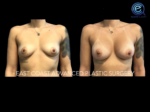 Breast Augmentation