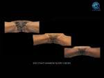 Vaginoplasty