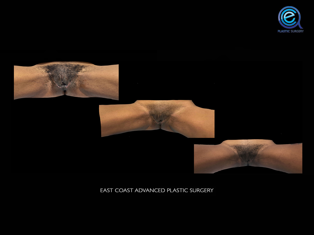 Vaginoplasty