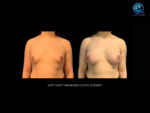 Chest Feminization