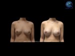 Breast Augmentation