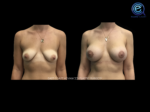 Breast Augmentation