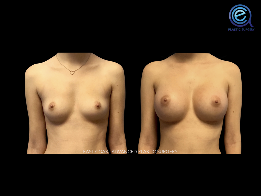 Breast Augmentation