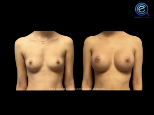 Breast Augmentation before and after photo by East Coast Advanced Plastic Surgery