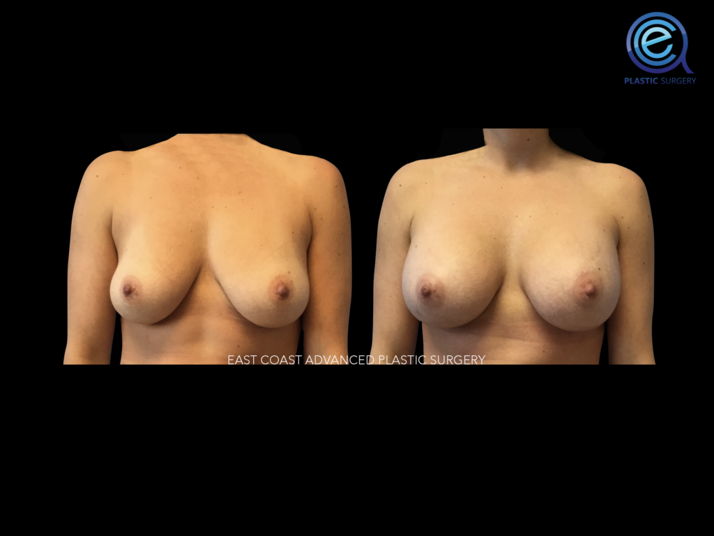 Breast Augmentation