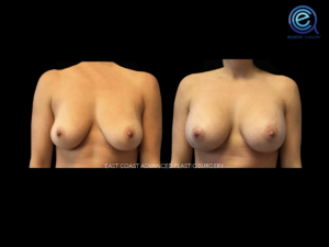 Breast Augmentation before and after photo by East Coast Advanced Plastic Surgery