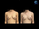 Bilateral Nipple Sparing Implant Based Reconstruction