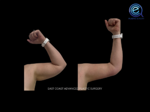 Brachioplasty before and after photo by East Coast Advanced Plastic Surgery (ECAPS), in New York, NY
