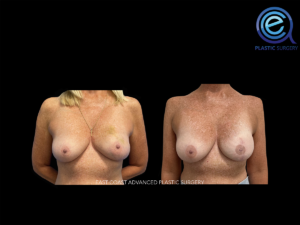 Unilateral Implant Based Reconstruction before and after photo by East Coast Advanced Plastic Surgery (ECAPS), in New York, NY