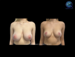 Breast Reduction