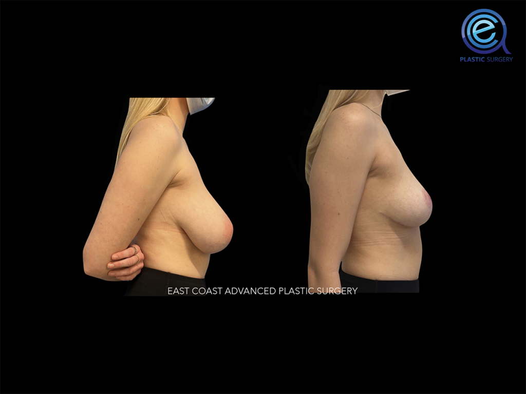 Breast Reduction