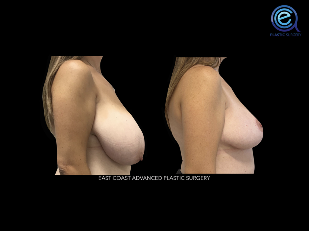 Breast Reduction