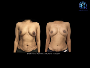 Bilateral Deep Inferior Epigastric Perforator Flap Reconstruction (DIEP) before and after photo by East Coast Advanced Plastic Surgery (ECAPS) in Hoboken, NJ