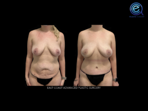 Bilateral Deep Inferior Epigastric Perforator Flap Reconstruction (DIEP) before and after photo by East Coast Advanced Plastic Surgery (ECAPS) in Hoboken, NJ