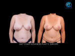 Unilateral Deep Inferior Epigastric Perforator Flap Reconstruction (DIEP)