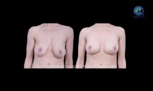 Bilateral Nipple Sparing Implant Based Reconstruction before and after photo by East Coast Advanced Plastic Surgery (ECAPS)