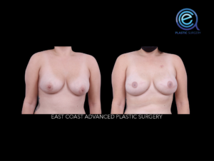 Bilateral Implant Based Reconstruction before and after photo by East Coast Advanced Plastic Surgery (ECAPS)