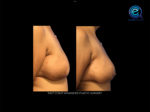 Nipple Reconstruction After Breast Reconstruction