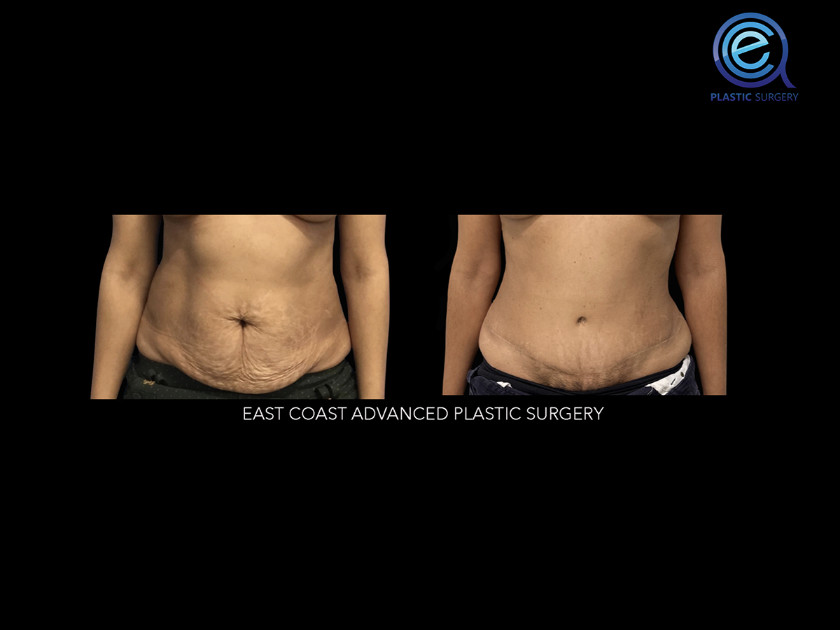 Abdominoplasty 