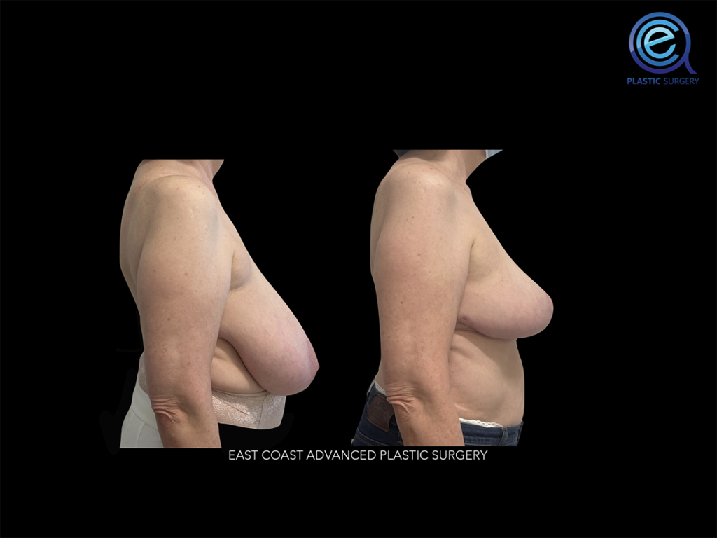 Breast Reduction