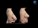 Breast Reduction