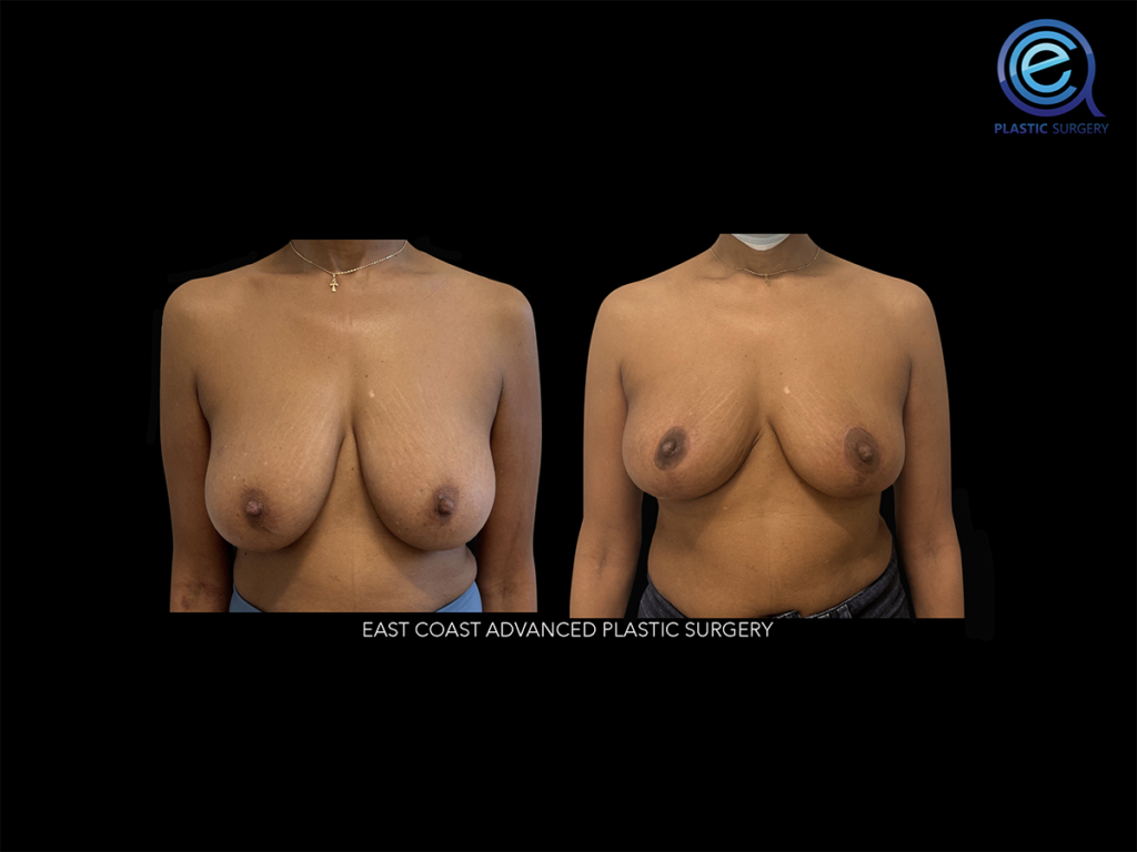 Oncoplastic Breast Reconstruction