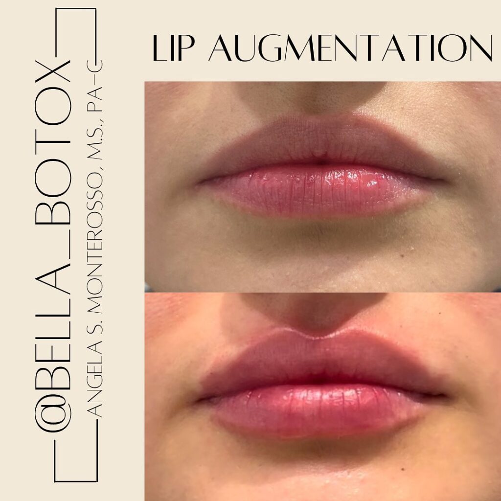 Lip Augmentation