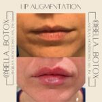 Lip Augmentation