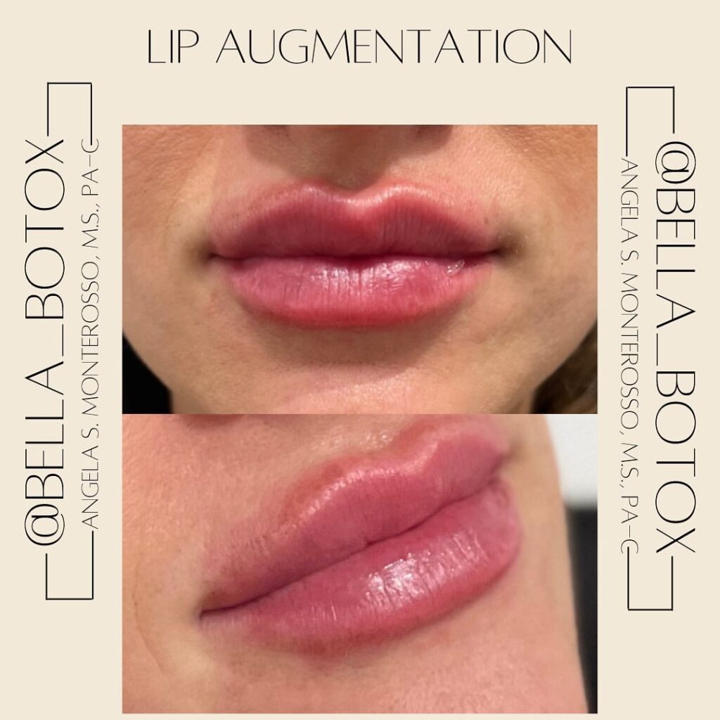 Lip Augmentation