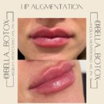 Lip Augmentation