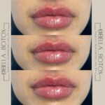 Lip Augmentation