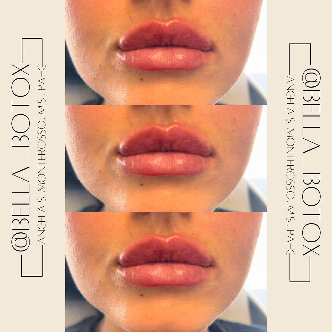 Lip Augmentation