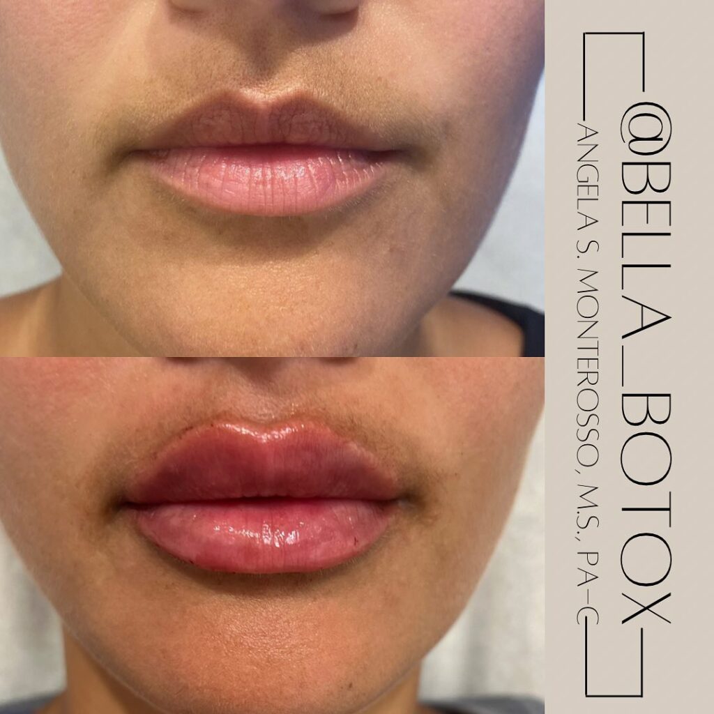 Lip Augmentation