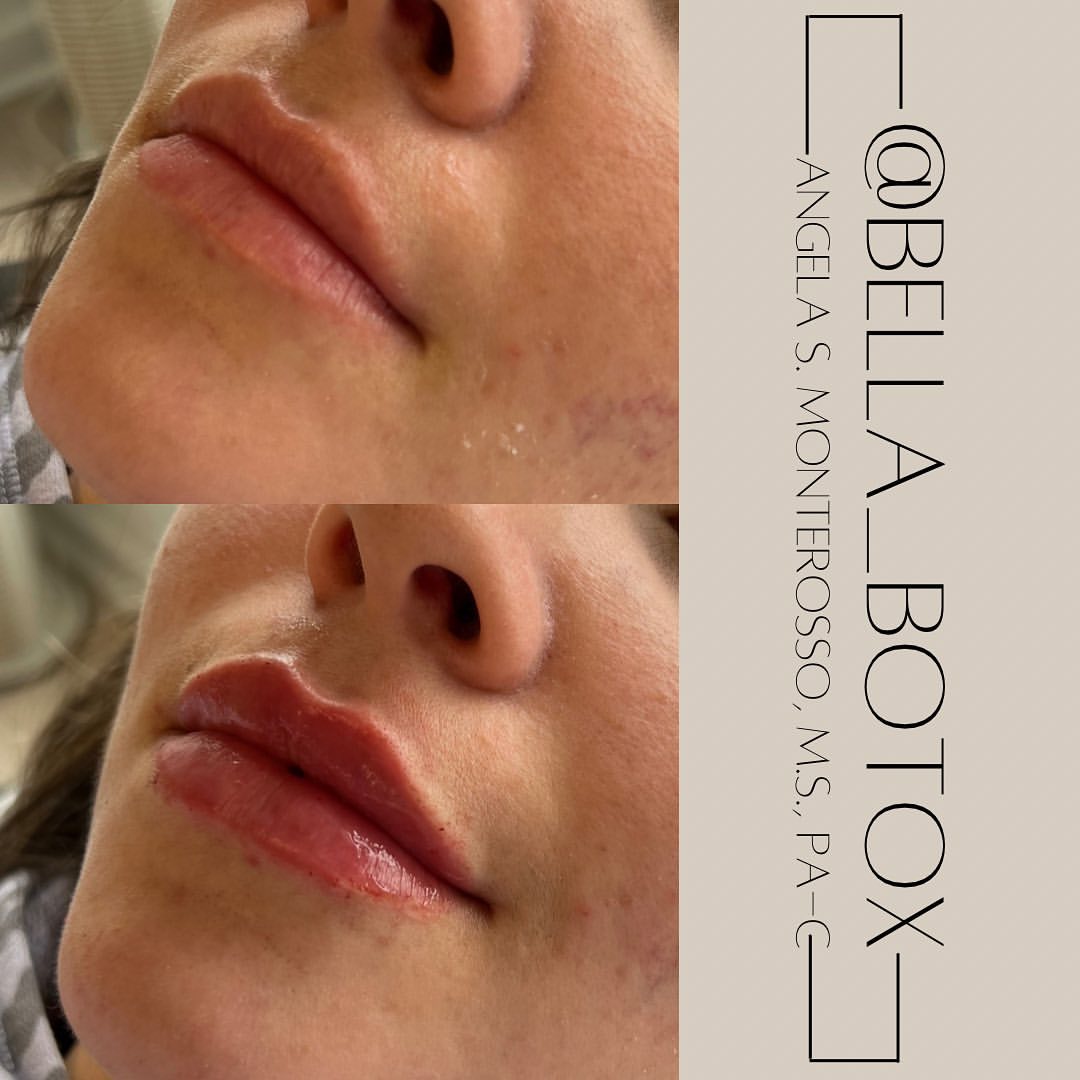Lip Augmentation