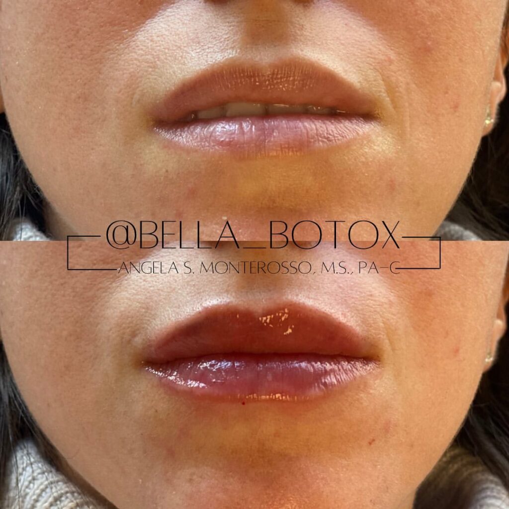 Lip Augmentation