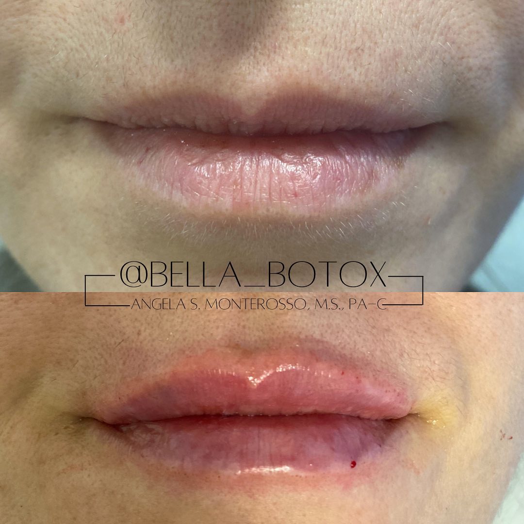 Lip Augmentation