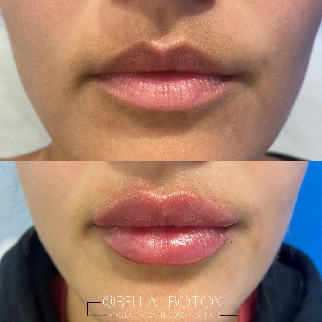 Lip Augmentation