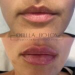 Lip Augmentation