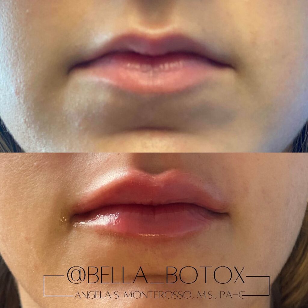 Lip Augmentation