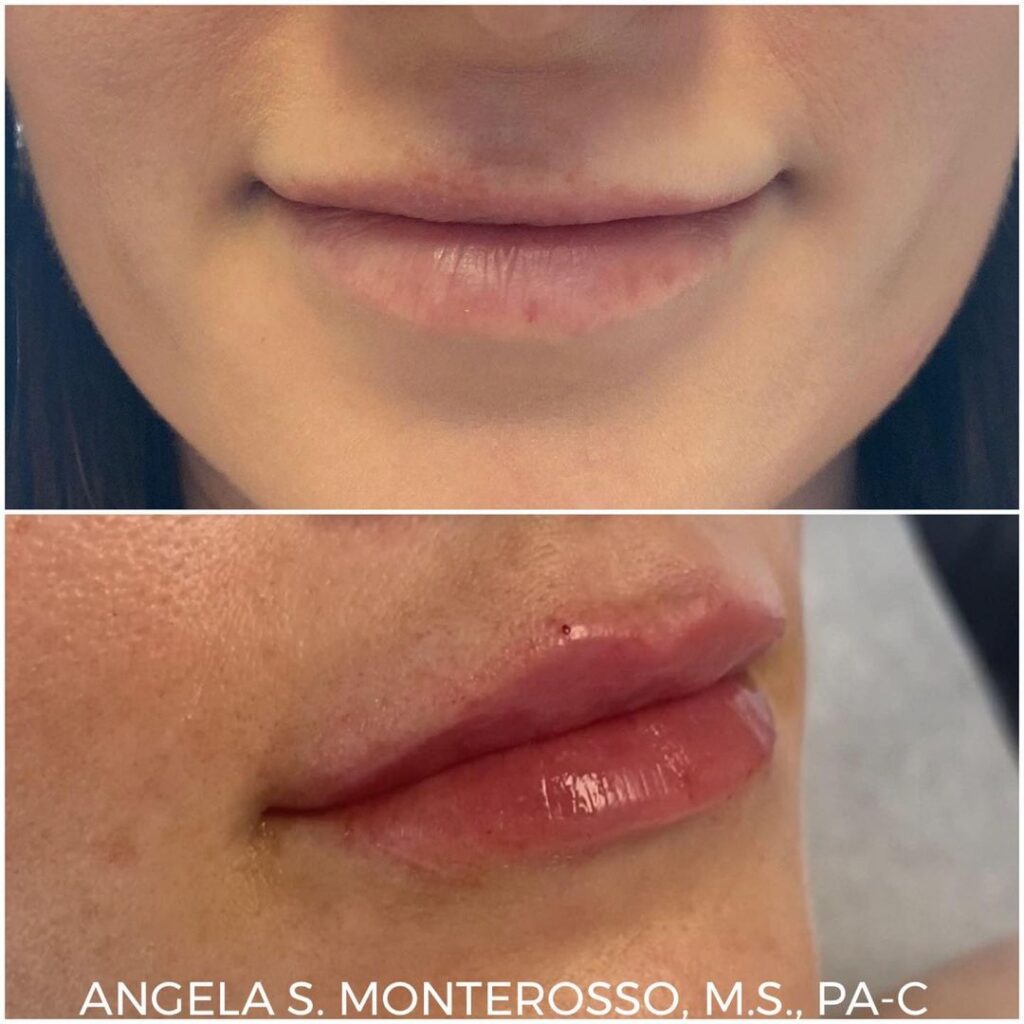 Lip Augmentation