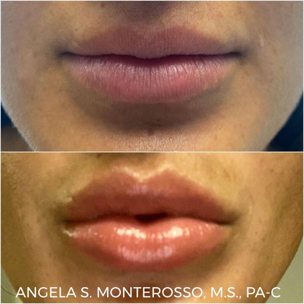 Lip Augmentation