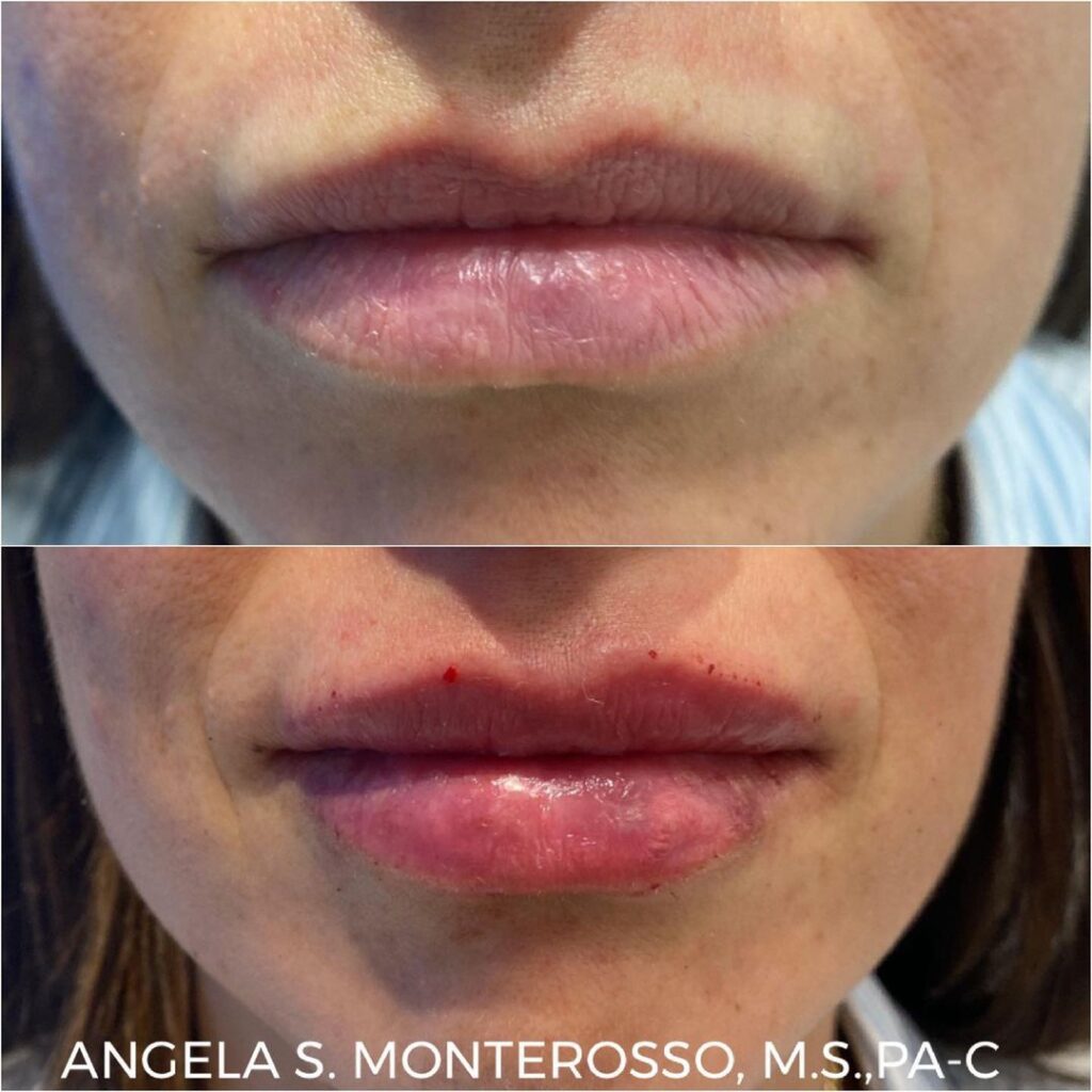 Lip Augmentation