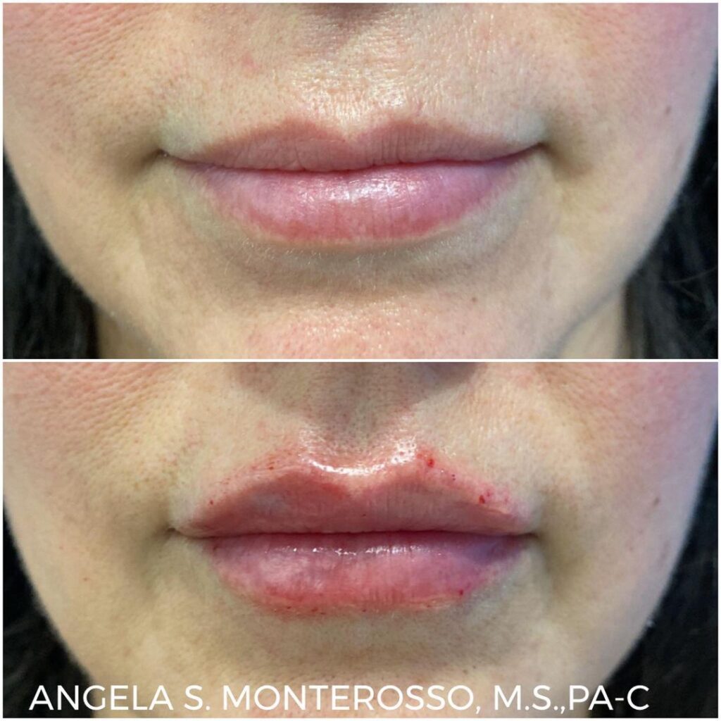 Lip Augmentation