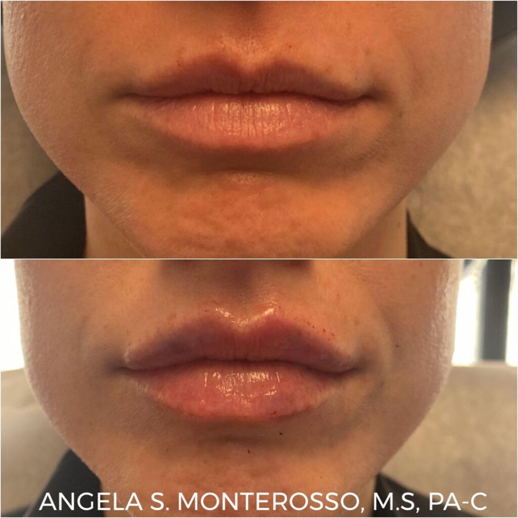 Lip Augmentation