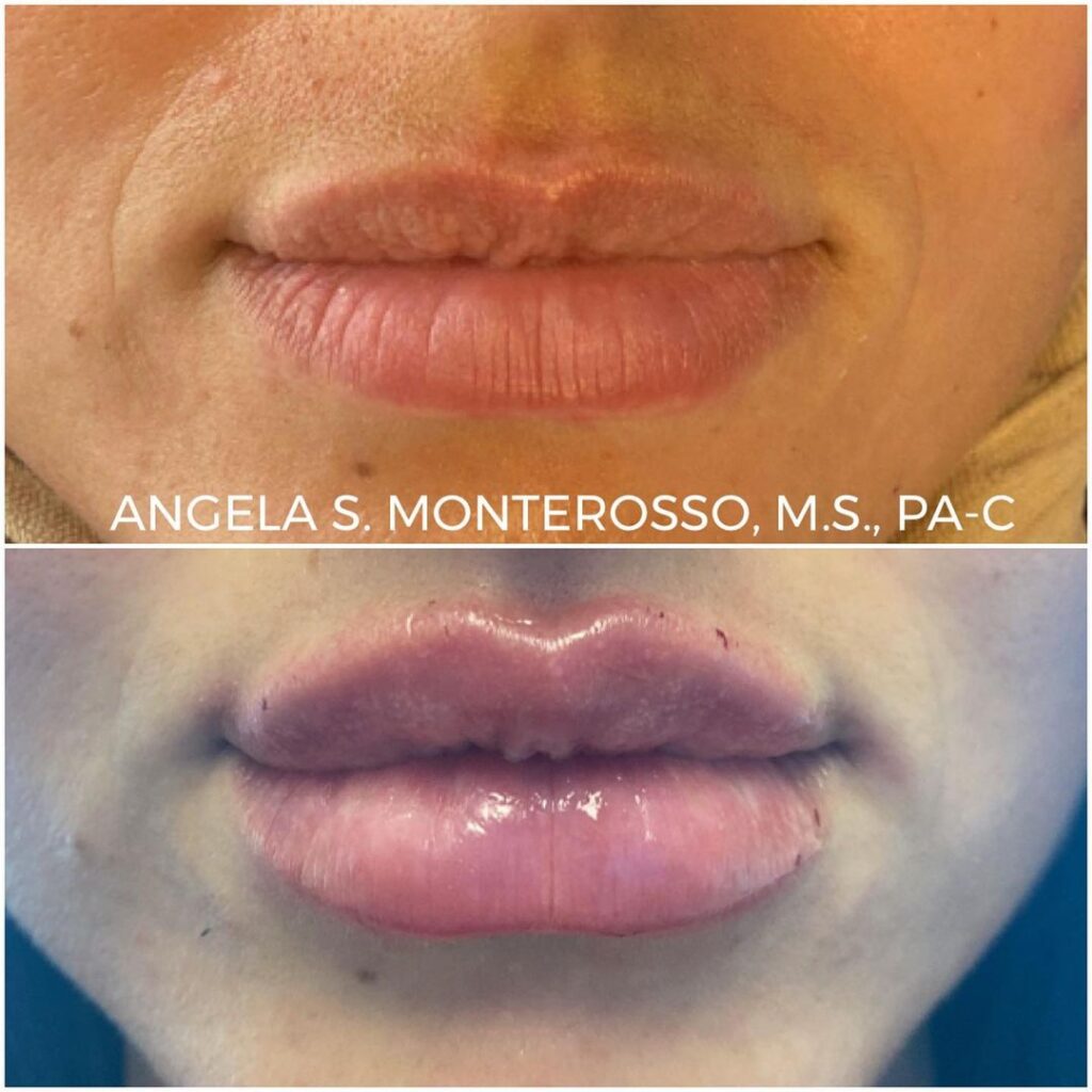 Lip Augmentation